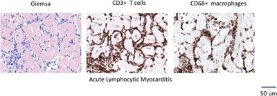 The inflammatory spectrum of cardiomyopathies